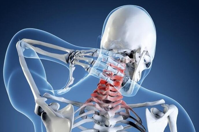 Osteohondroza prvog stupnja