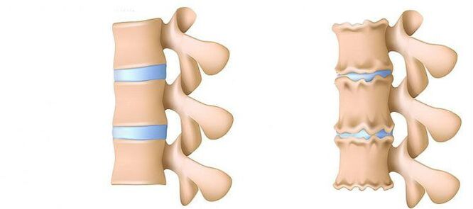 Osteohondroza lumbalne regije