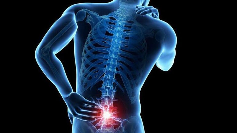 Simptomi lumbalne osteohondroze